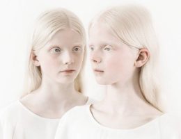 Чудо генетики: 5 уникальных явлений во внешности человека