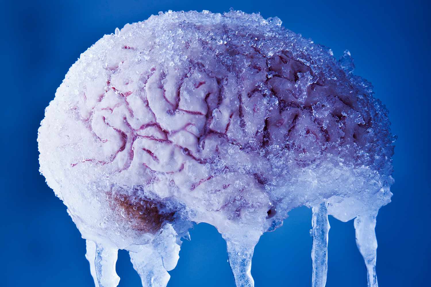 Замораживание мозга